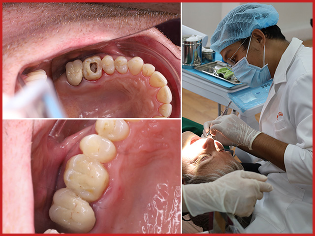 Root canal treatment