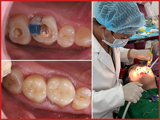 Root canal treatment