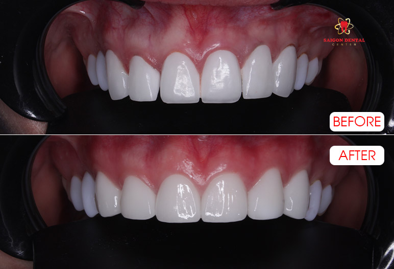 Dental crowns