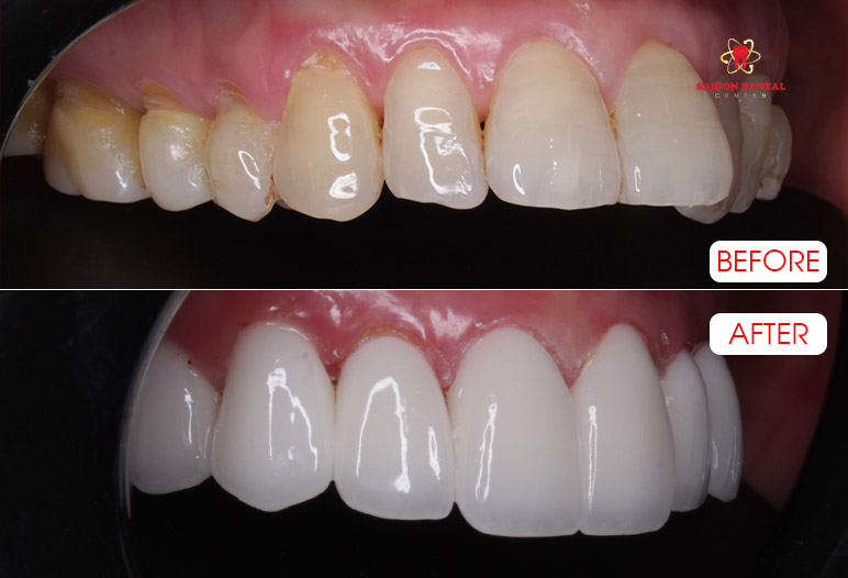 Dental crowns