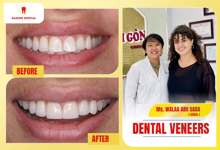 Dental veneers