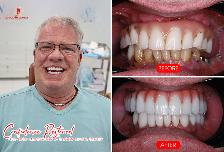 Cấy ghép Implant