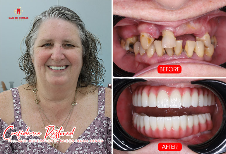 Cấy ghép Implant