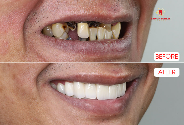 Dental crowns