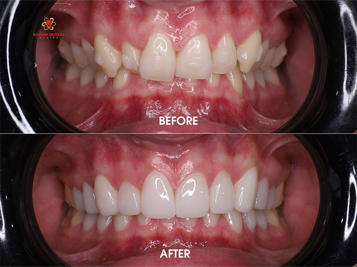 Dental veneers