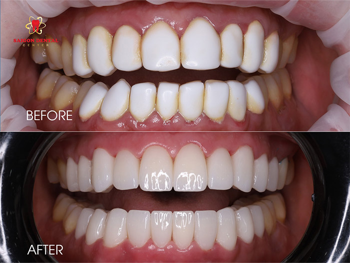 Dental veneers