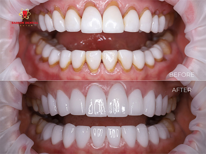 Dental veneers