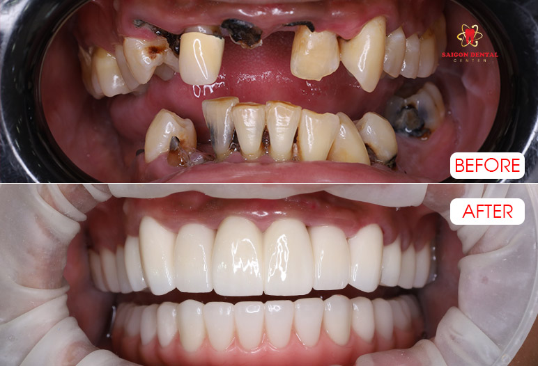 Dental crowns
