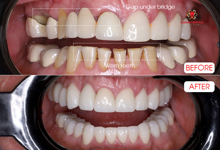 Dental crowns