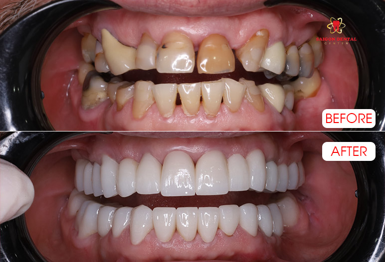 Dental crowns