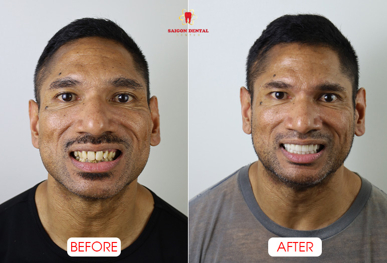 Dental crowns