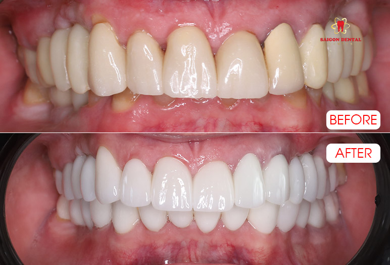 Dental crowns
