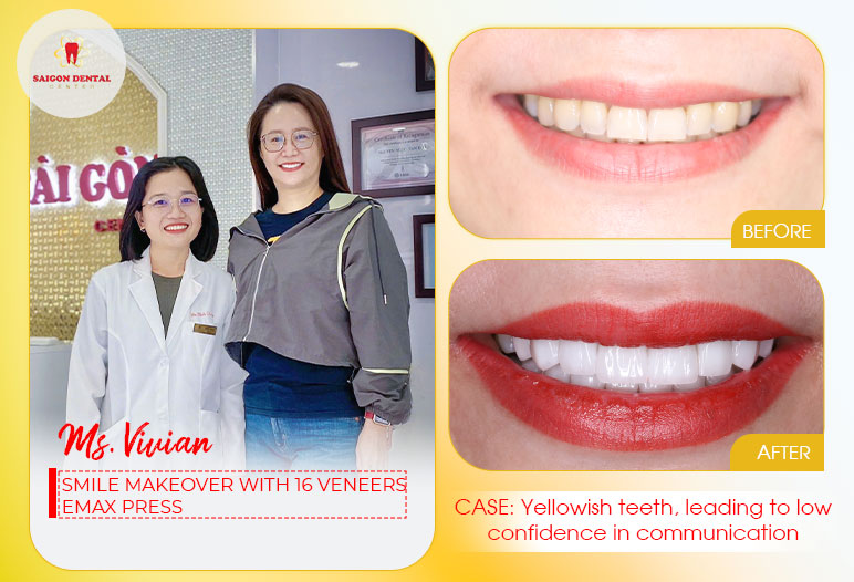 Dental veneers