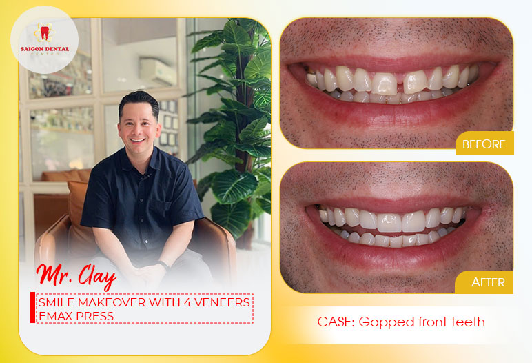 Dental veneers