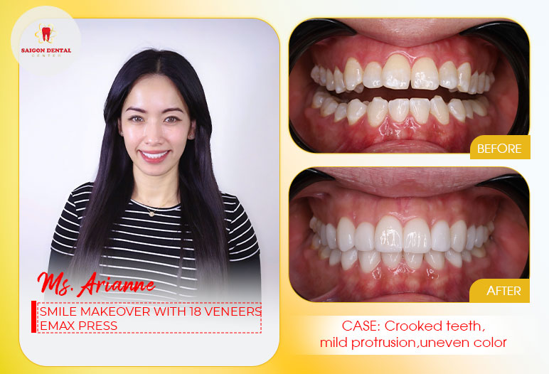 Dental veneers