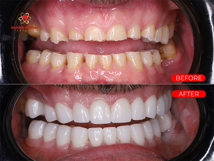 Dental veneers