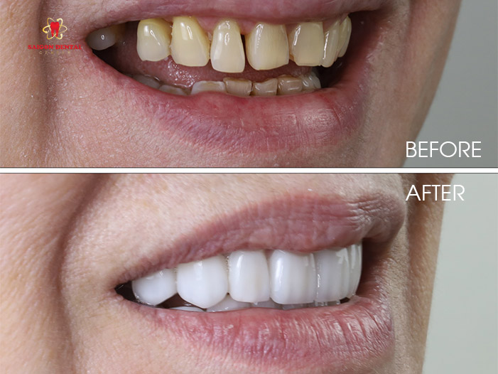 Dental veneers