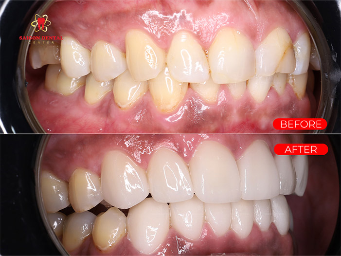 Dental veneers