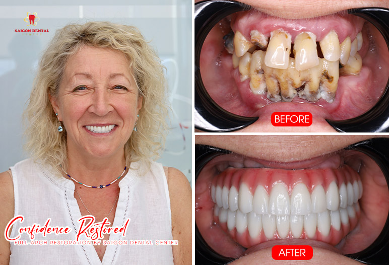 Cấy ghép Implant