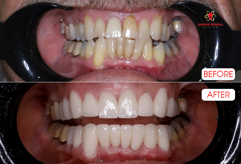 Dental crowns
