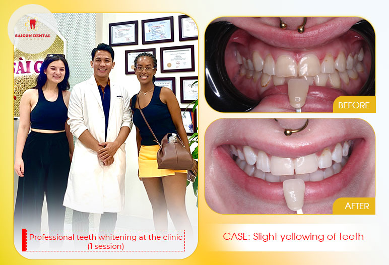 Teeth whitening