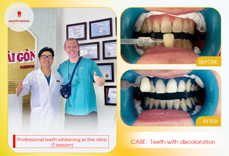 Teeth whitening