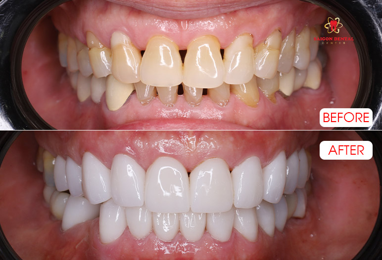 Dental crowns