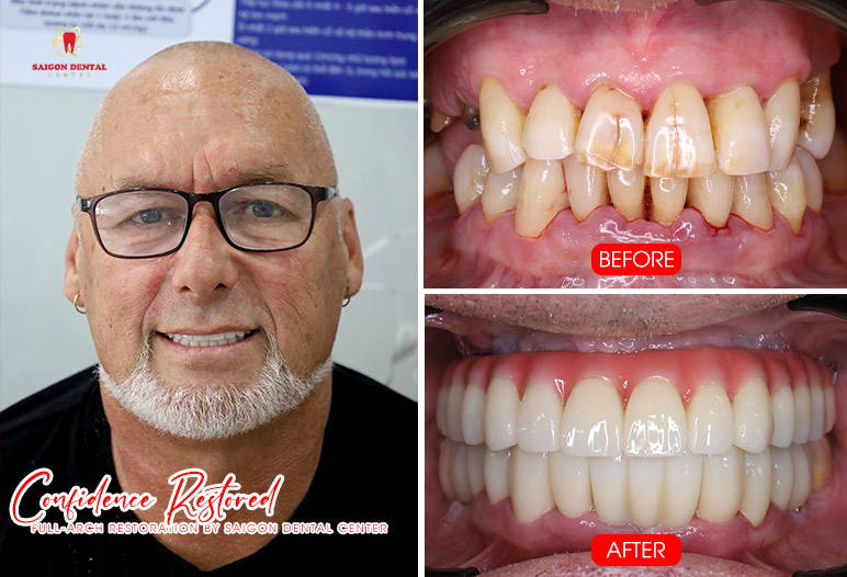 Cấy ghép Implant